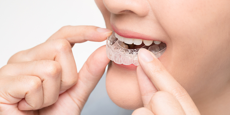 Invisalign