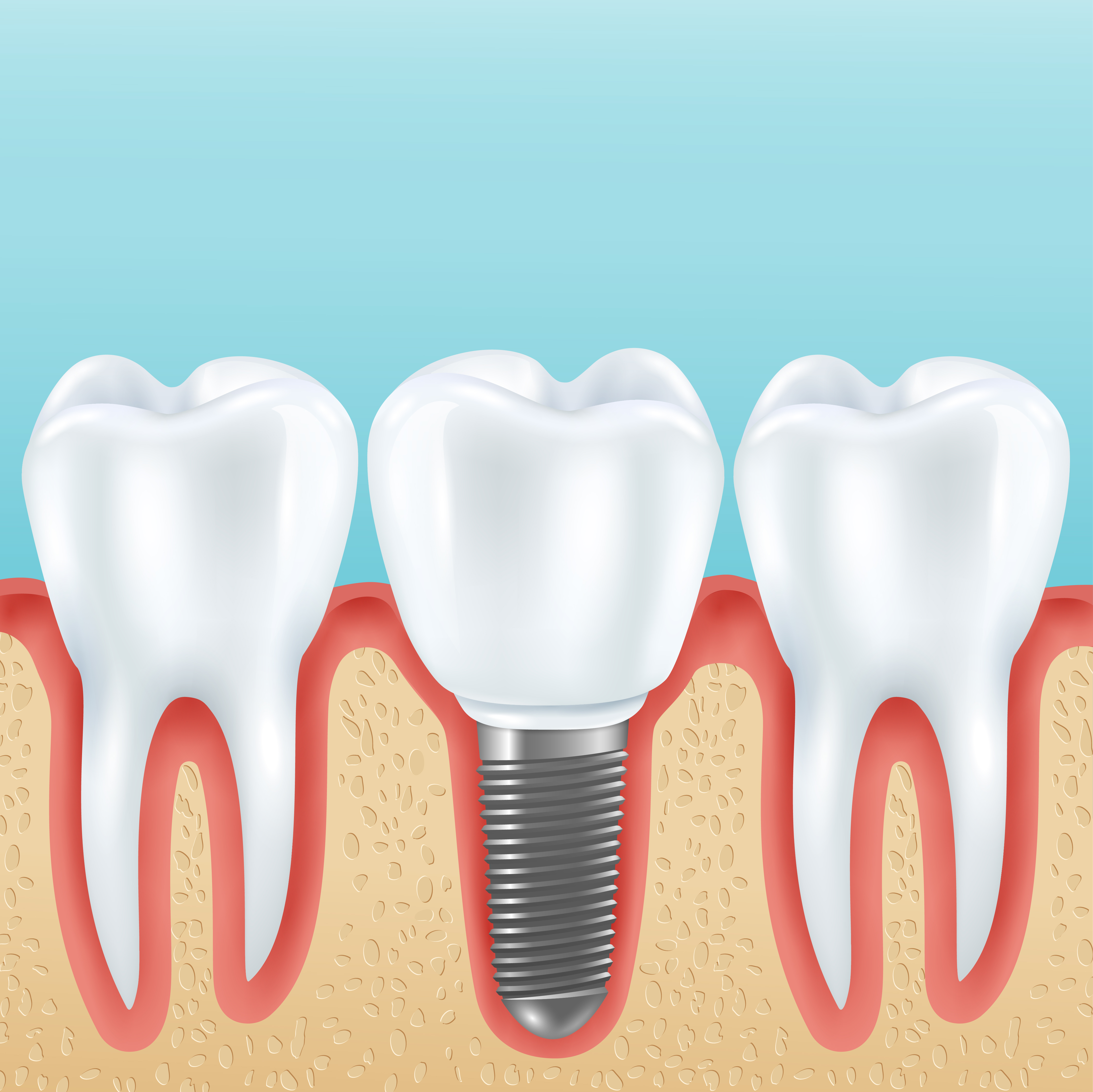 Dental Implant